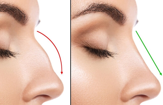 Những biến chứng thường gặp sau khi nâng mũi