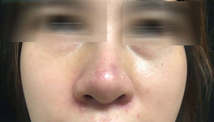 Nguyên nhân bị nổi mụn ở mặt sau khi thực hiện nâng mũi