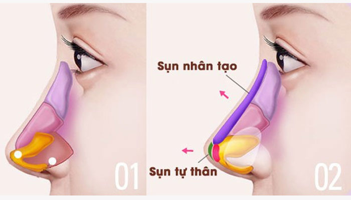 Chất lượng sụn nâng mũi ảnh hưởng đến nâng mũi cấu trúc bị lệch