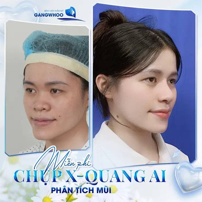 Review 3 Địa Chỉ Nâng Mũi Ở Trà Vinh Uy Tín, An Toàn