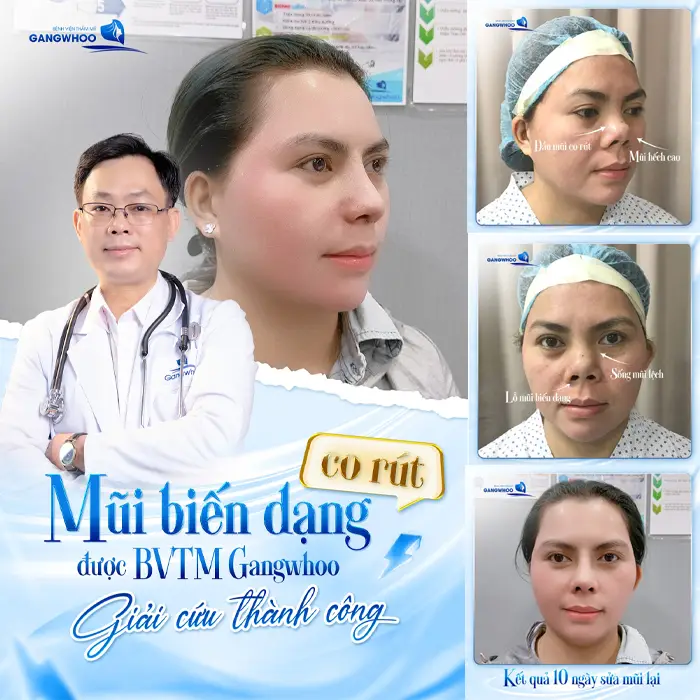 Review 3 Địa Chỉ Nâng Mũi Ở Trà Vinh Uy Tín, An Toàn